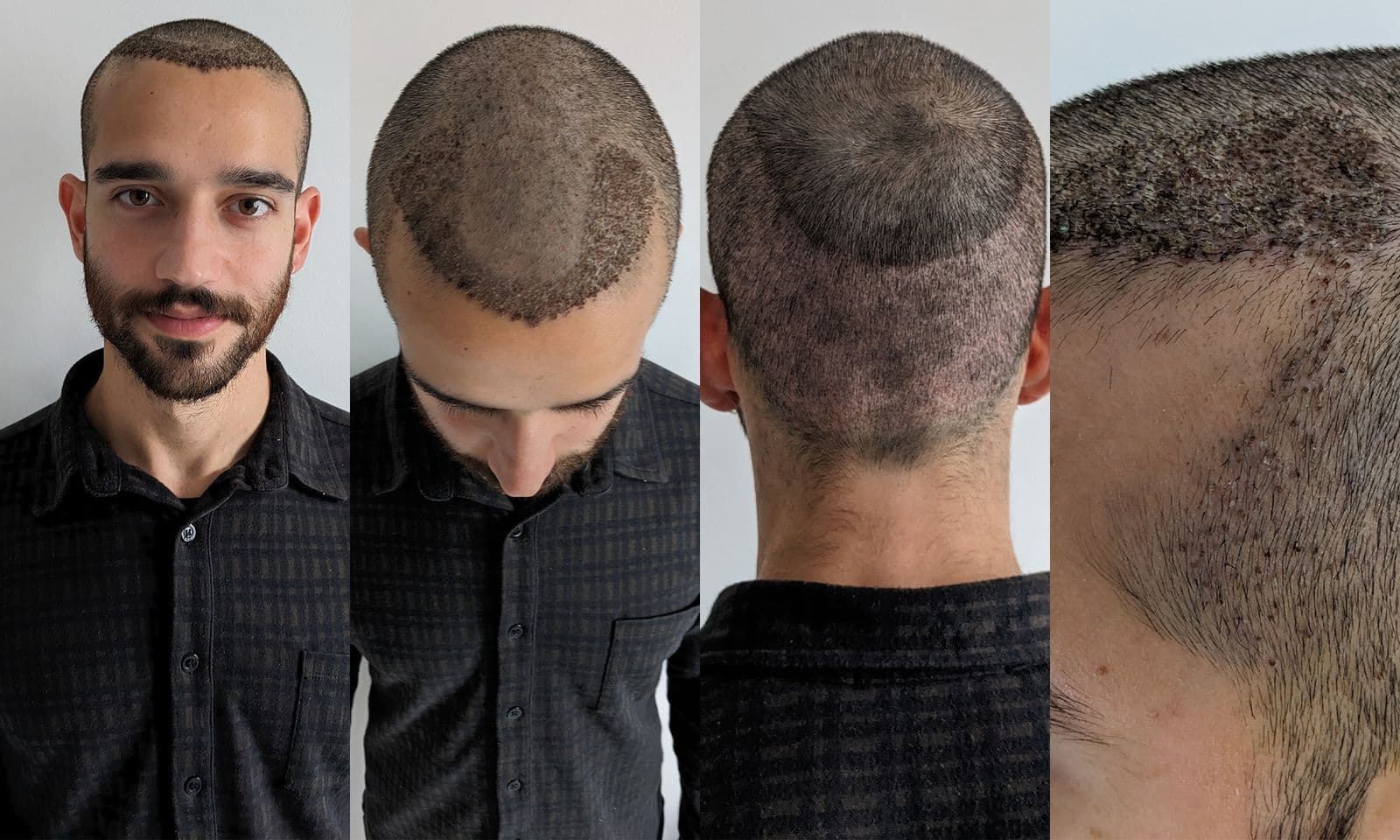 NYC Hair Replacement That Feels Like Your Own